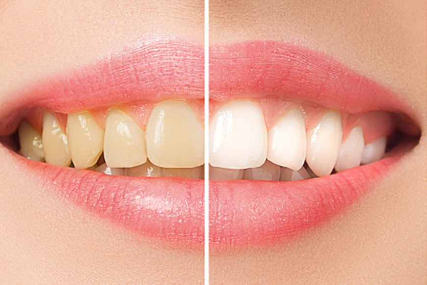 Here is About Teeth Whitening