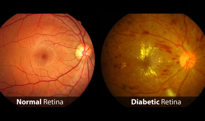 Diabetic Retinopathy