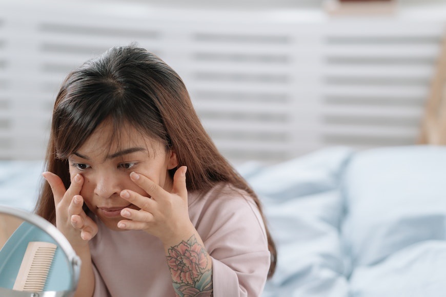 can dermatologists treat dark circles