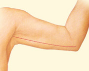Arm Lift Brachioplasty Surgical Procedure at Thumbay University Hospital