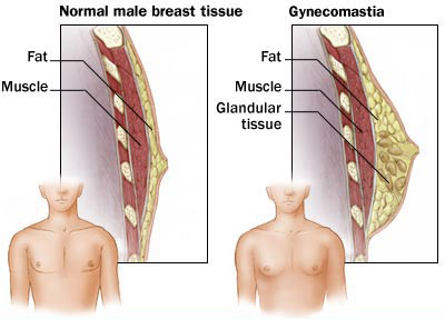 Gynecomastia Large Breasts in Males Treatment at Thumbay University Hospital