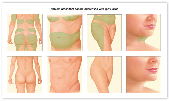 Problem Areas That Can Be Addresses With Liposuction