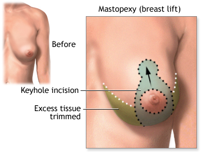 Breast Lift or Mastopexy in Ajman at Thumbay University Hospital