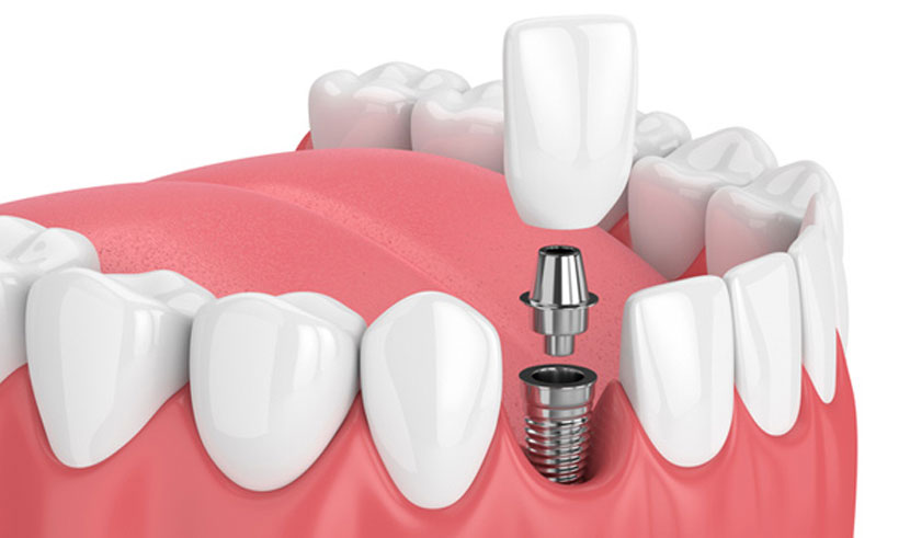 Implants a Long-standing Solution to Dental Needs