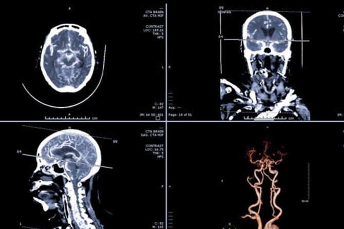 What is cerebral angiography?
