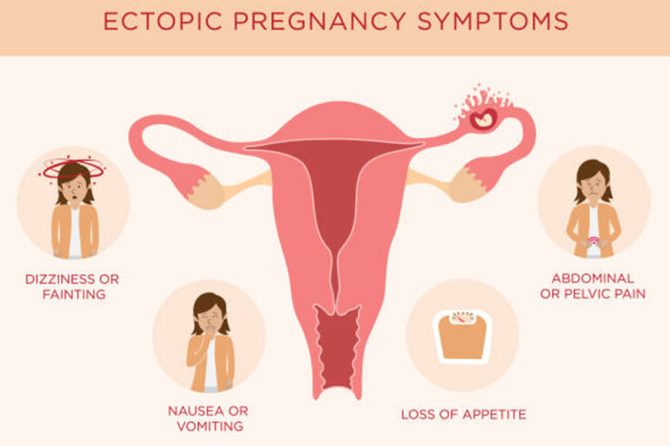 Medical and surgical management of ectopic pregnancy