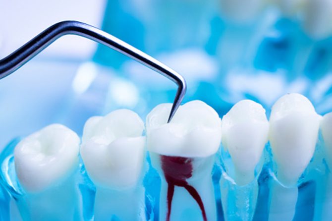 Here is About Root Canal