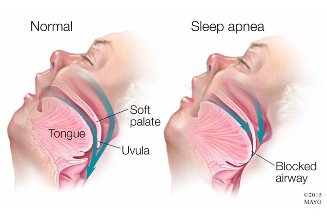 Obstructive Sleep Apnea (OSA)