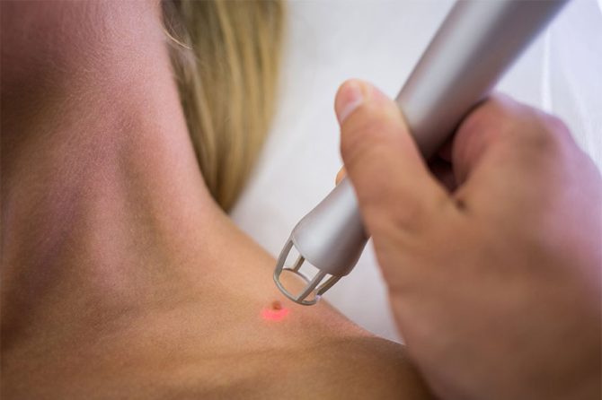Know Before You Ignore: The Impact of Warts